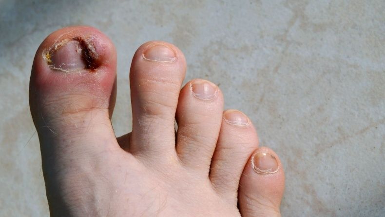 Close-up van een rood gezwollen grote teen met beschadigde nagelrand