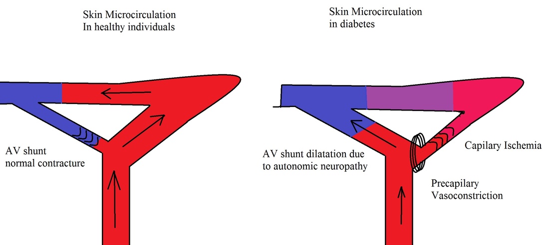 Medische illustratie die de microcirculatie van de huid vergelijkt bij gezonde personen (links) versus mensen met diabetes (rechts). Het toont hoe autonome neuropathie bloedvaten beïnvloedt, wat leidt tot AV-shuntdilatatie, precapillaire vasoconstrictie en capillaire ischemie bij diabetespatiënten, sleutelfactoren bij diabetische voetcomplicaties.